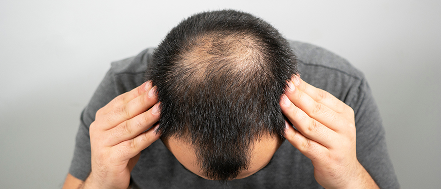 5 tips voor mannen met dun haar